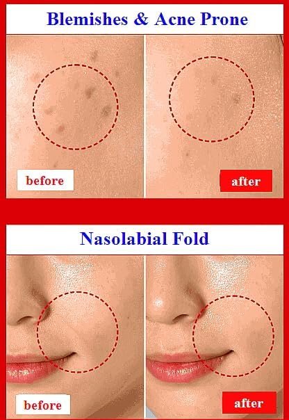 ULTIMATE [Human Stem Cell + (10%) PDRN] Healing Booster Overnight Serum―for Minimizes Wrinkles, Discoloration (10ml x 5vials)