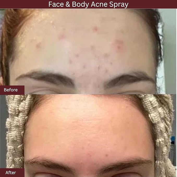 ITK Skincare 2% Salicylic Acid Spray for Face & Body Acne - Blemish-Fighting Treatment for Body Acne, Bacne, Blackheads, Pimples & Blemishes - BHA Blemish Facial Mist Post Workout - 3.3oz Spray Bottle