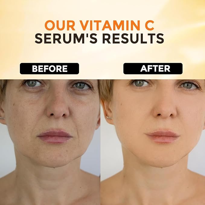 Vitamin C Face Serum With Hyaluronic Acid - Anti Aging Serum - Reduce Dark Spots, Professional Grade Treatment For Face & Eyes