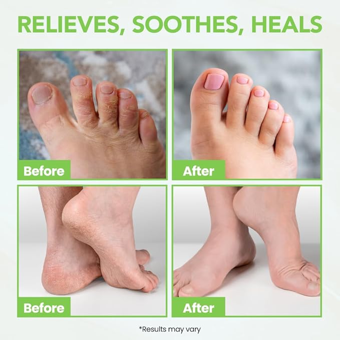 THENA Athletes Foot Treatment Balm Extra Strength, Tea Tree Foot Cream, Heals Dry Cracked Feet Heels Itchy Skin Nails Toenails Advanced Foot Care for Men Women