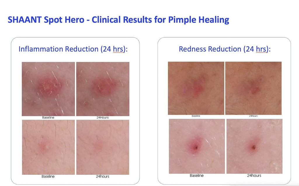 Codex Labs Shaant Spot Hero – Sulfur & Green Tea Gel for Blemish-Prone Skin | Fast-Drying Formula for Clear-Looking Skin | 0.5oz