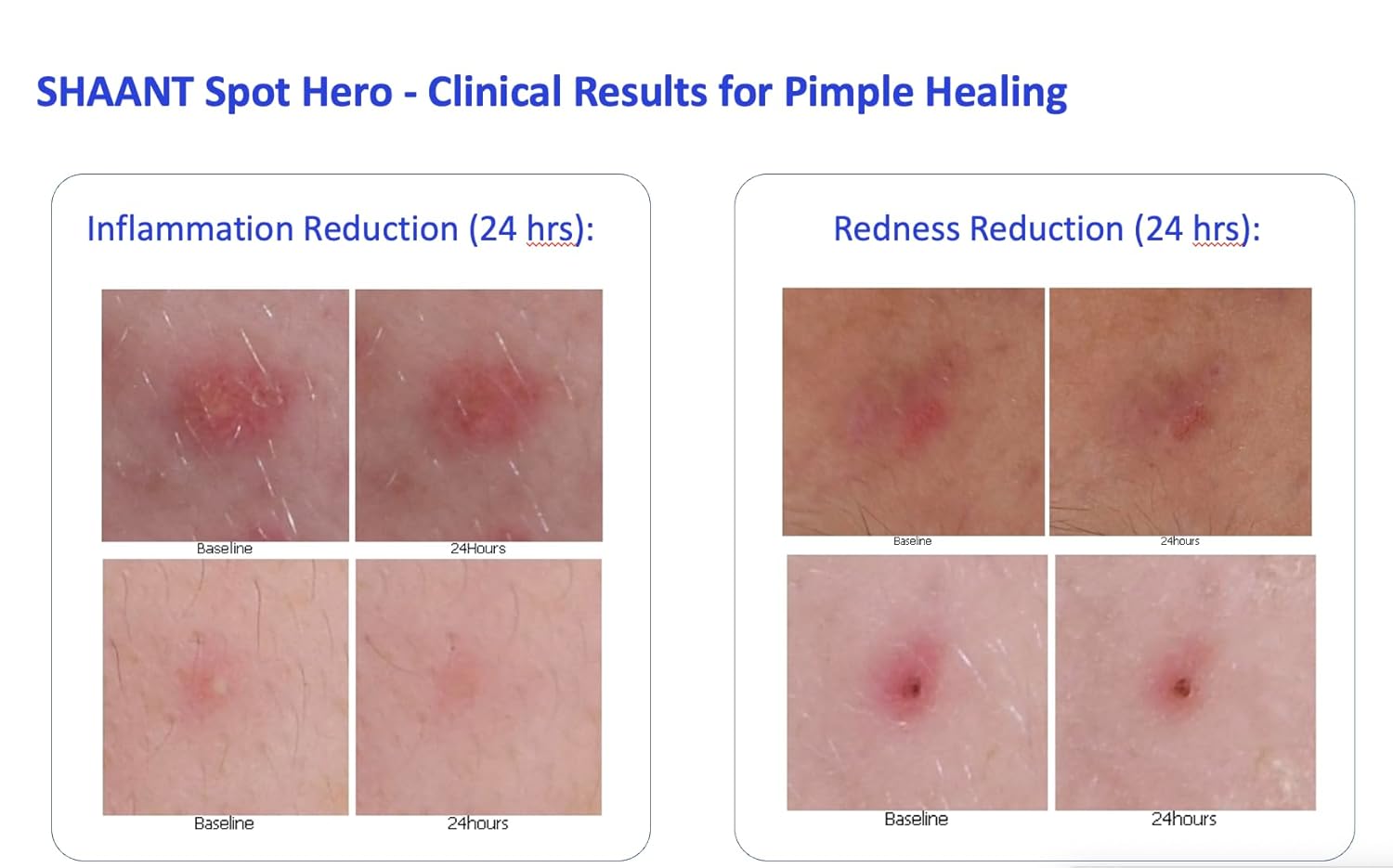 Codex Labs Shaant Spot Hero – Sulfur & Green Tea Gel for Blemish-Prone Skin | Fast-Drying Formula for Clear-Looking Skin | 0.5oz