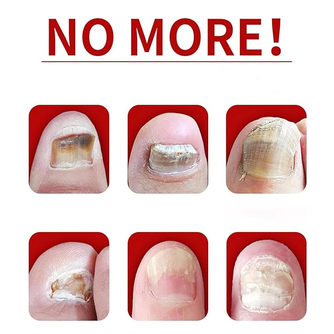 2PCS Ginger Nail Treatments, 7 Days Ginger Cuticle Care Oil for Nails,Nail Repair Cuticles Oil,Ginger Nail Oil for Strengthen nails & Promote Nail Growth, Natural Plant Formula