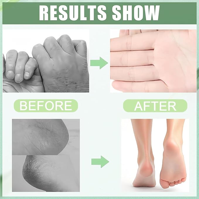 2Pcs 60% Urea Foot Cream Set, Hydrating Lotion Stick Balm, Hand and Foot Cream Urea Moisturizer, Moisturizing Cream 60 Percent for Feet Maximum Strength, 40G Each