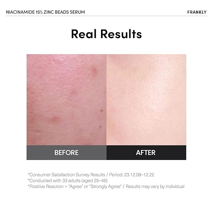 FRANKLY Niacinamide 15% & Zinc Beads Serum Jumbo: Acne & Dark Spots Care, Oil Control, Even Skin Texture & Glow | Vegan & Cruelty-Free | Non-Comedogenic All skin types Korean Skincare | 2.02 fl.oz