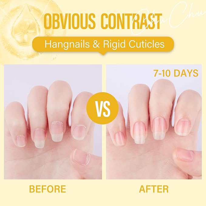 CHUCHU Organic Cuticle Oil for Nails: Pineapple Jojoba Nail Oil with Vitamin B & E - Moisturizes Repairs and Promotes Nail Growth - Prevents Dryness Hangnails and Chapped Skin 15ML