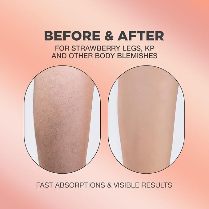 Strawberry Legs Exfoliating Serum + KP Body Cream Bundle | Keratosis Pilaris and Strawberry Legs Skincare Formula for Smooth and Dewy Skin | Strawberry Treatment Bundle for Clear Skin