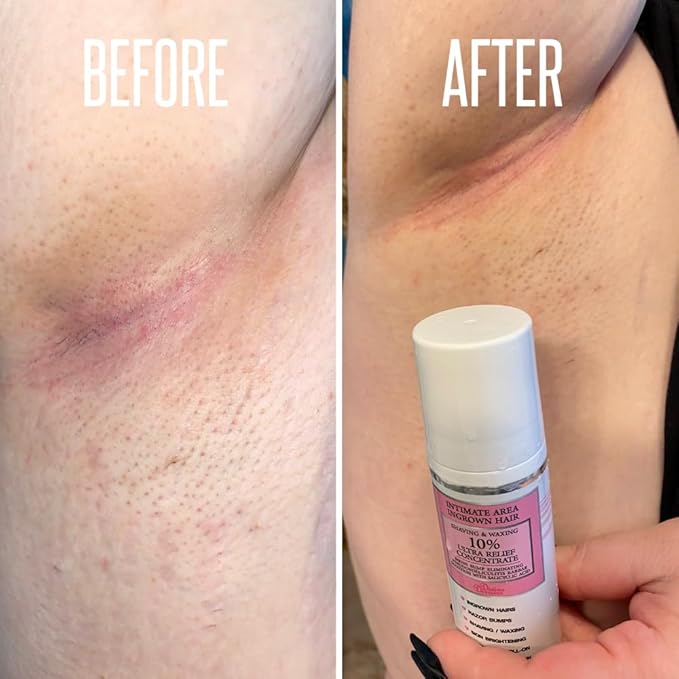 Save 14% on The Skin Care Solution For Dark Spots, Razor Bumps, Ingrown Hair & Razor Burns – Includes Our Ultra Potent Brightening + Razor Bumps Solution For an Ultra Clear & Glowing Skin