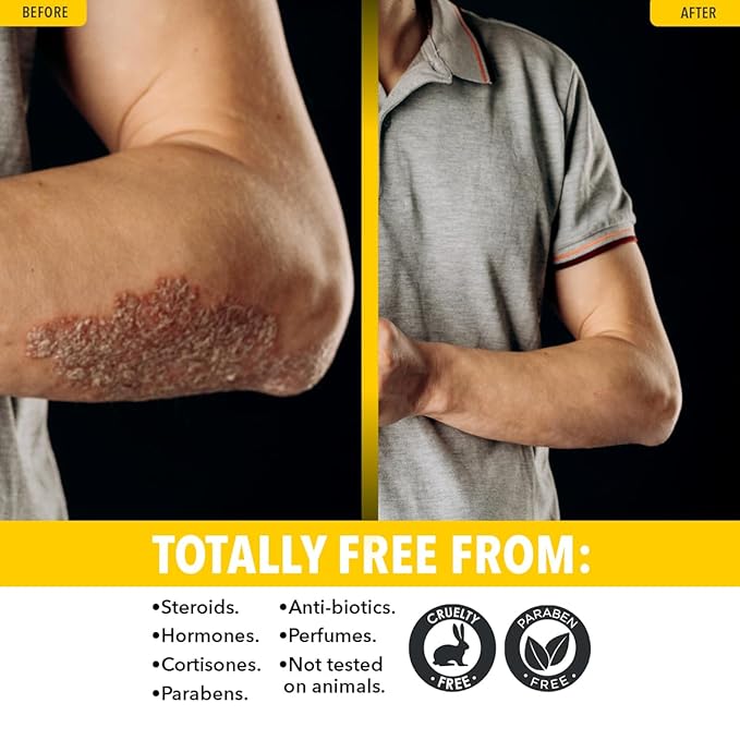 Dr. Robaina Sulfur Balsam Lotion – Daily Moisturizing Lotion for Eczema and Psoriasis Relief – Soothes Redness, Hydrates Sensitive Skin – Natural Ingredients – Made in the USA (Pack of 3)