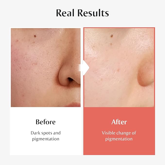 [Redence] 5% Niacinamide & 605,395ppm Natural Vitamin C Tone & Spot Serum for glow & Hydration - Gentle, Non-Sticky for Sensitive Skin, 1 fl Oz