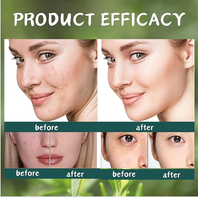 5 Pcs Tea Tree Acne Trea-tment for Face Skin Care Kit - Skin Care for Teens 10-12 - Skincare Gift Set - Acne Kit with Cleanser,Serum,Toner,Gel,Cream - Mother's Day Gifts for Mom