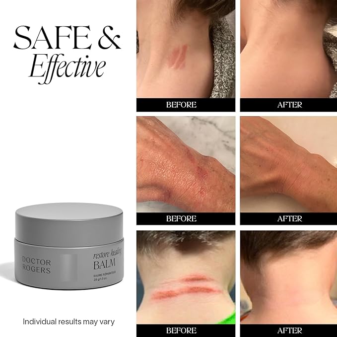 Doctor Rogers Restore Healing Balm. Multi-Purpose Healing Ointment & Moisturizing Eczema Relief Gel. Protects & Soothes Injured, Sensitive & Dry Skin, 1 Ounce (28 g) Jar