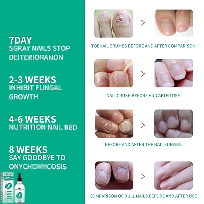 Kerassentials Toenail Oil, Kerassentials Nails Nutrient Oil, Nail Repair Solution 30ML/1PCS (4PCS)