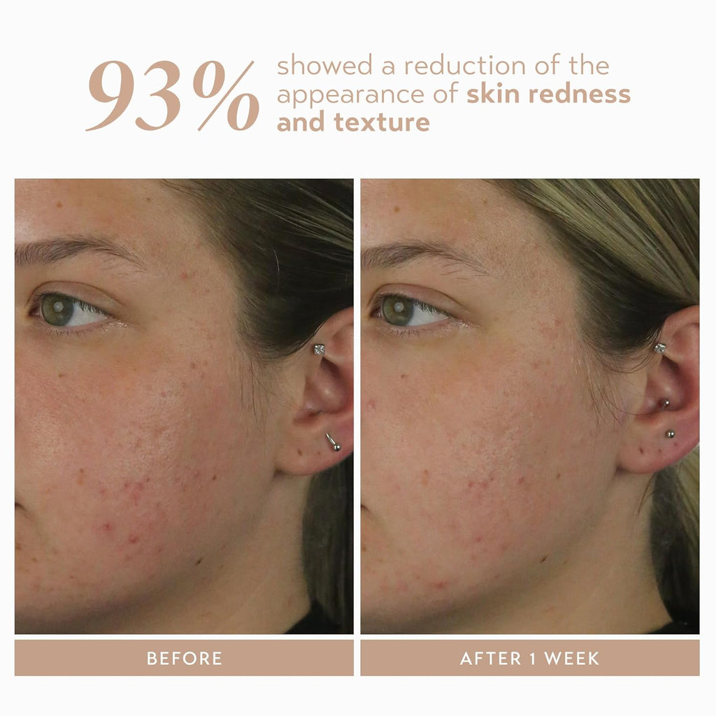 Shani Darden Rescue Serum with 10% Azelaic Complex, Lightweight Hydrating Azelaic Acid Serum for Face with Oat Kernel & Aloe Extracts, Helps Skin Redness & Acne, Non-Comedogenic, Vegan, 1 fl oz