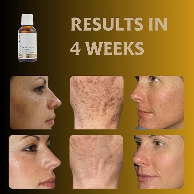 Luxury Swiss Dark Spot Remover for Face Body Serum Age Sun Brown Spot Freckles Corrector Melasma treatment Anti aging Skin Vitamin C + Niacinamide organic Magiclear