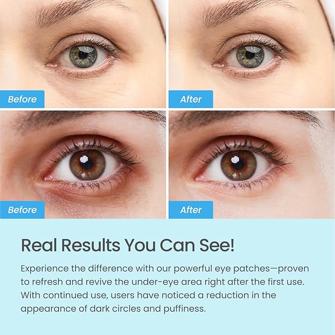 PLANTIFIQUE Superfood Under Eye Patches – 12 Pairs with Hyaluronic Acid for Dark Circles & Puffy Eyes – Anti-Aging Skincare Gel Mask, Gift for Women & Men