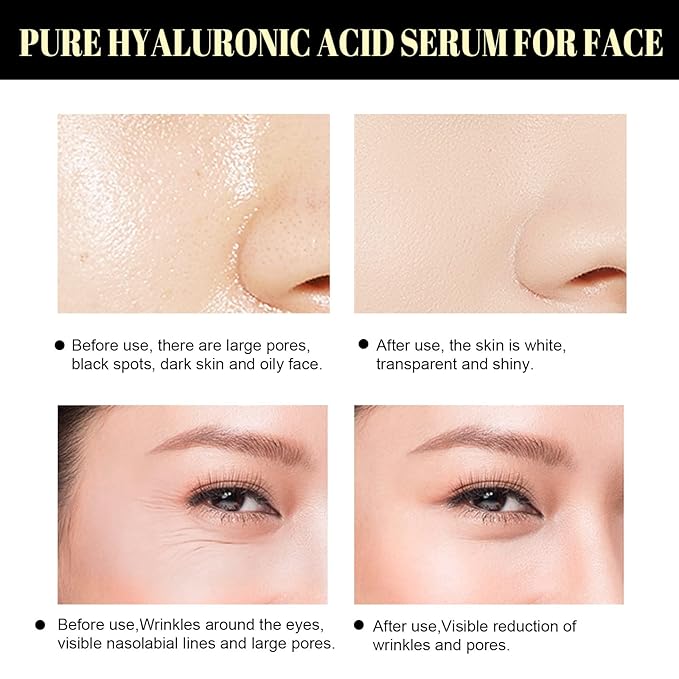 Protein Thread Lifting Set, Soluble Protein Thread and Nano Gold Essence Combination, Absorbable Collagen Thread for Face Lift, Reverse Collagen Serum for Face (With 1 x Protein Thread)