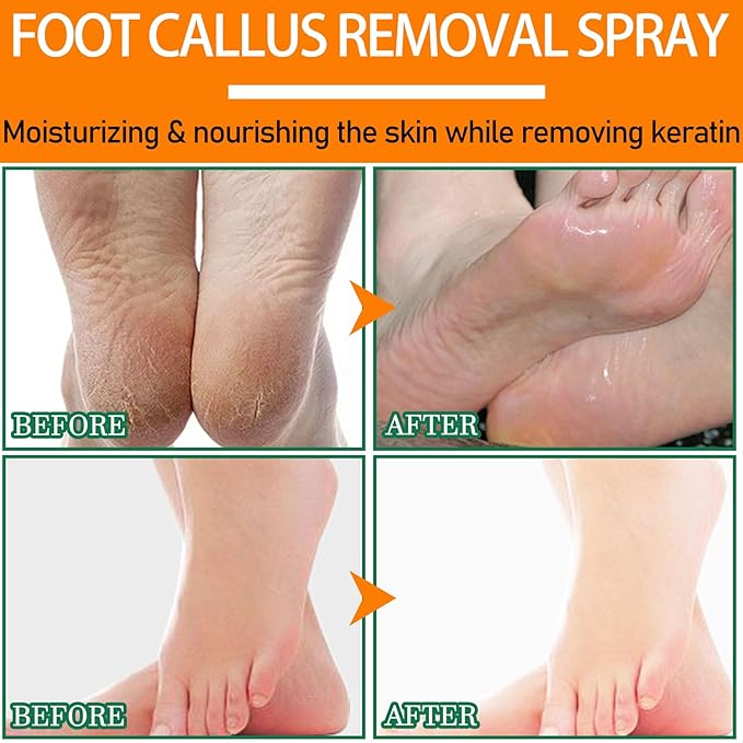 Foot Peel Spray Orange Oil,Refreshing and Moisturizing Foot Exfoliating Cleansing Spray for All Skin Types,Instant Foot Peeling Spray to Remove Dead Skin