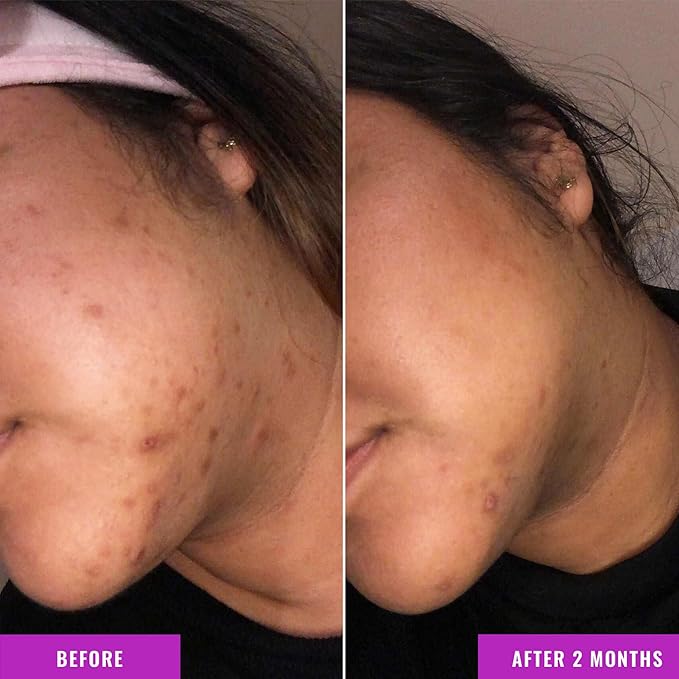 Good Molecules Discoloration Correcting Serum - Tranexamic Acid Ester Salt and Niacinamide for Dark Spots, Sun Damage, and Age Spots - Skincare Face