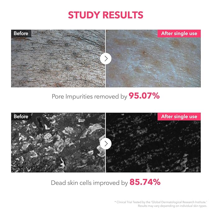 APRILSKIN TXA Niacinamide 99 Pore Care Pink Bubble Gum Deep Cleanser | 99% High-Purity TXA+Niacinamide | All-in-One Cleanser: Deep Cleansing, Blackhead Care, Pore Care, Moisturizing | 4.23 fl.oz.