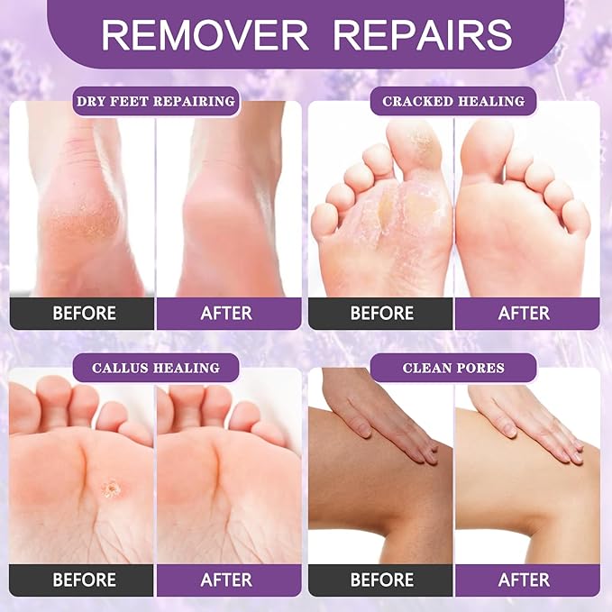 foot salt set Foot Soak with Epsom Salt - For Toenail Repair, Athletes Foot, Softens Calluses, Soothes Sore & Tired Feet…