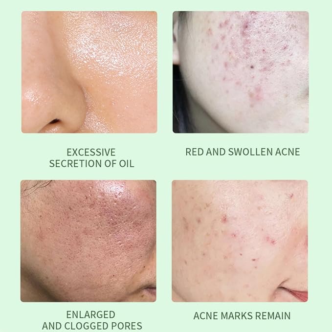 Acne Treatment Serum with 2% Salicylic Acid & Niacinamide-Centella Asiatica Facial Repair Oils for Sensitive & Acne-Prone Skin Acne Spot Treatment Gentle Spot Care Oil Control, 1 Fl Oz