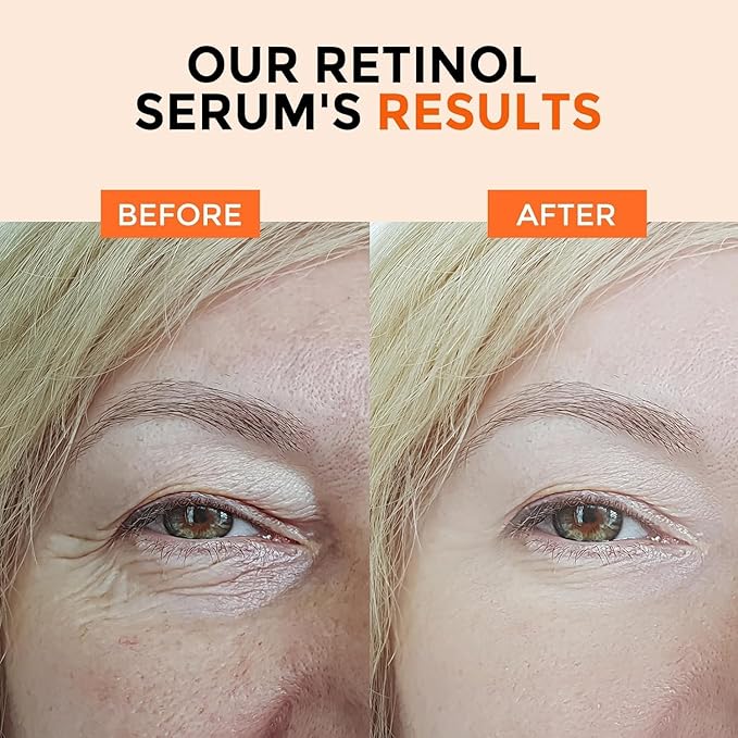 Retinol Serum for Face 2.5%, B5 Herbal Resurfacing Retinol with Vitamin C, Vitamin E, Hyaluronic Acid, Anti-Aging, Wrinkle Smoothing, Dark Spot Corrector, Brighten Dullness 2 Packs