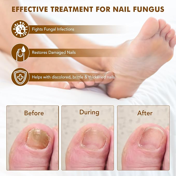 Ginger Nail Treatment, Nail Growth Serum, Ginger Nail Serum, Nail Repair Cuticles Oil, Ginger Nail Oil for Strengthen nails & Promote Nail Growth, Natural Plant Formula