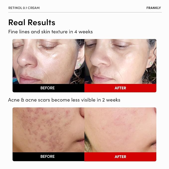 FRANKLY Skin Repair Duo: Retinol 0.3 Cream & Butter So Much Cream | Anti-Aging & Skin Turnover | Deep Moisturization | Vegan Butter, Jojoba Oil | Vegan & Curelty-Free | Korean Skincare Set