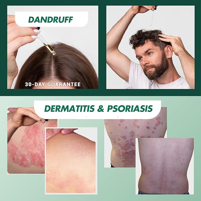 ABERA Alan Silver Serum - Clinically Proven to Soothe Irritated Skin and Improve The Appearance of Skin with Mild to Moderate Psoriasis