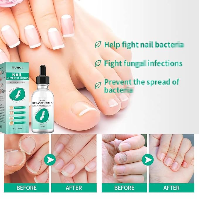 Kerassentials Toenail Oil, Kerassentials Nails colourless (3PCS)