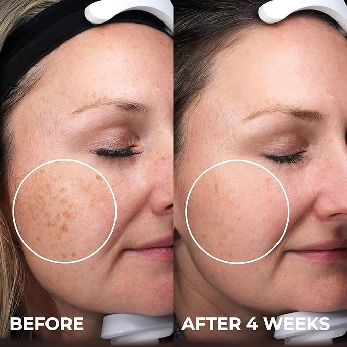 Abera Skin Renewing Serum, Melasma Treatment For Face, High-Performance Anti-Aging, High Potency Saffron Extract, Hydrating Serum,1.01 Fl Oz