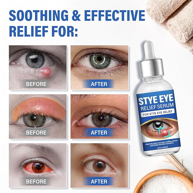ITECFREELY Stye Eye Treatment, Natural Stye Eye Relief Drops Serum for Styes Chalazion and Blepharitis, Fast Chalazion Remover for Restore Healthier Skin(1 Fl.oz)