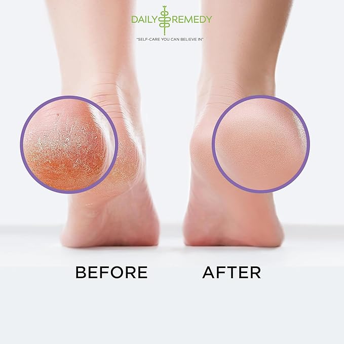 Daily Remedy Calming Lavender Foot Soak with Epsom Salt - 2 PACK -Foot Soak Soothes Sore Tired Feet, Athletes Foot & Remove Foot Odor. Best Foot Spa Pedicure Set