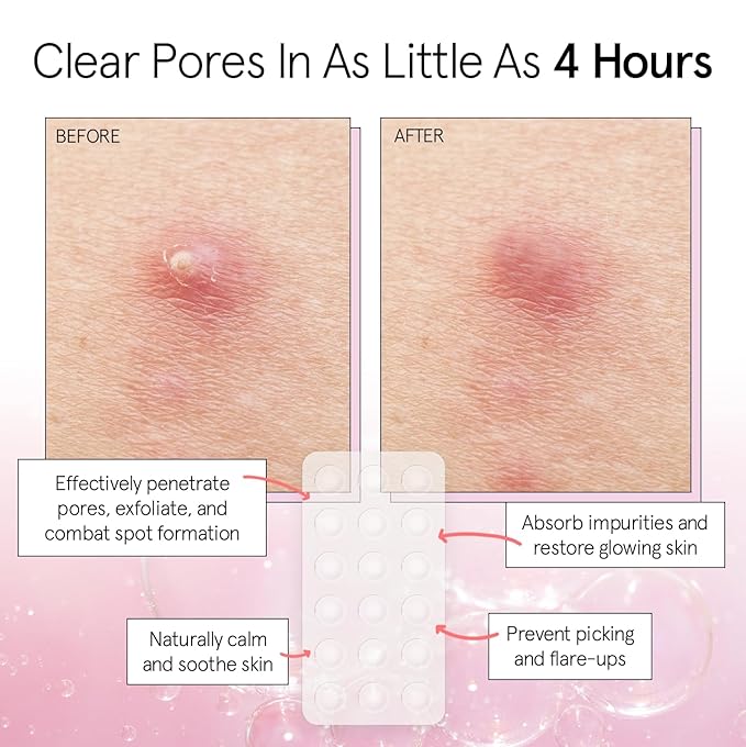 grace & stella Pimple Patches for Face - Fast Acting Hydrocolloid Acne Patch That Absorb Gunk, Flatten Breakouts - Zit Stickers for Clear Skin - Dermatologist-Tested, Vegan (Invisible, 72 Count)