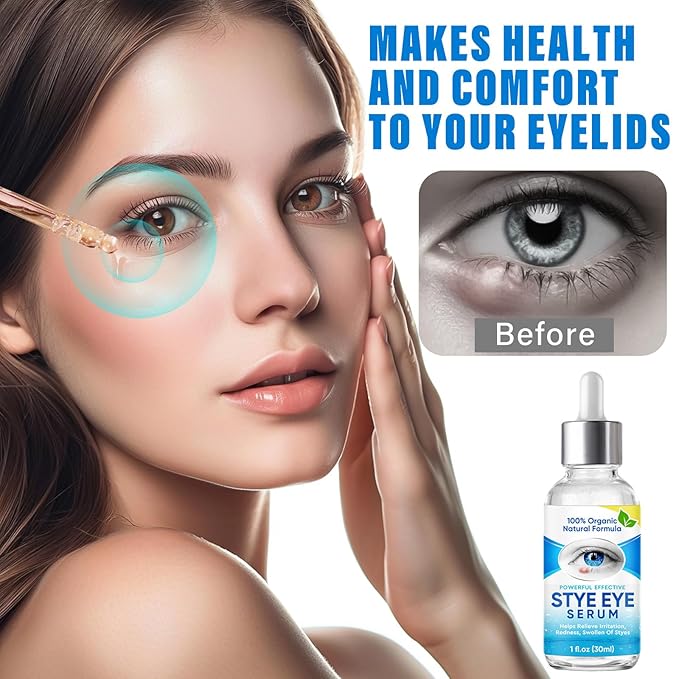 Stye Eye Treatment, Natural Stye Eye Relief Serum, for Styes Chalazion and Blepharitis Treatment, Restored Healthier Eye Skin, Blue