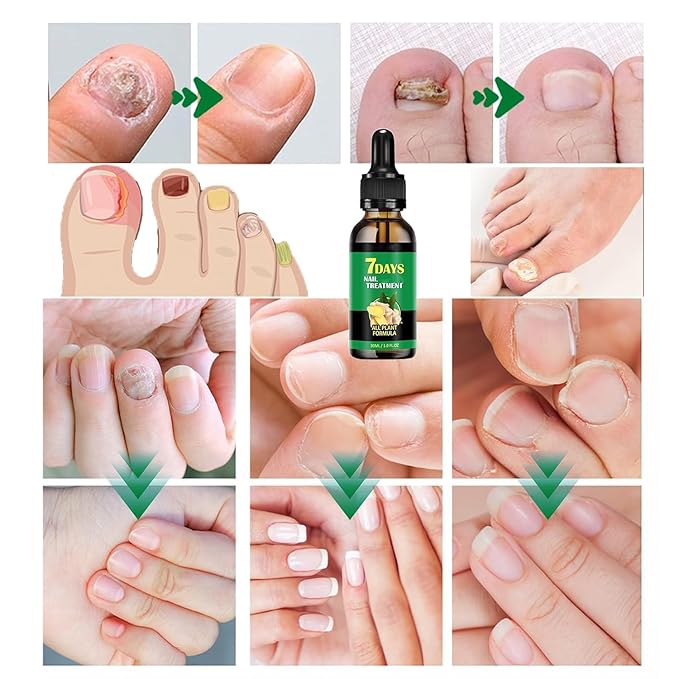 2PCS Ginger Nail Treatments, 7 Days Ginger Cuticle Care Oil for Nails,Nail Repair Cuticles Oil,Ginger Nail Oil for Strengthen nails & Promote Nail Growth, Natural Plant Formula