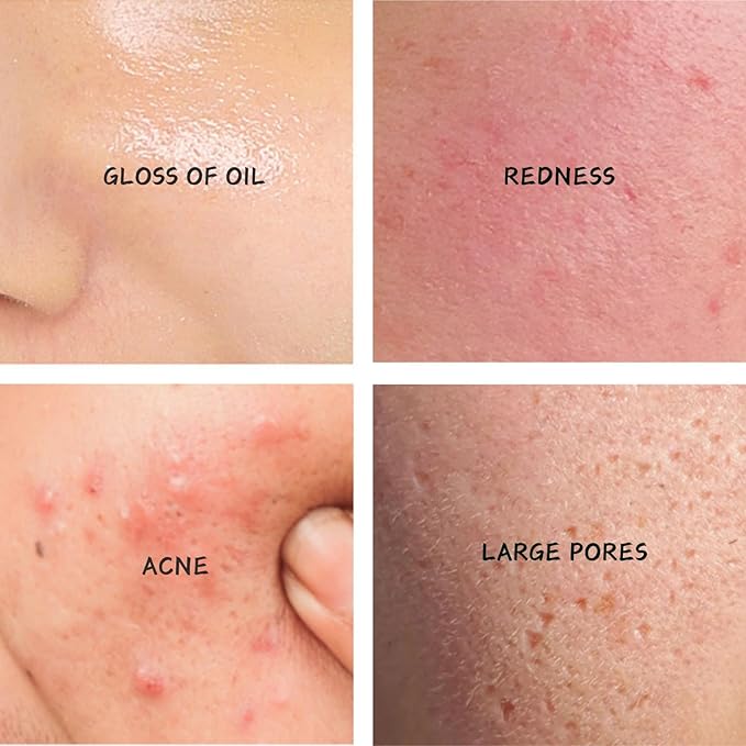 Tea Tree Salicylic Acid Skin Care Kit Teen Girl Gifts - 4 Pcs Skin Care Set Women Hydrating - Skin Care for Teens 10-12 - Acne Treatment for Face - Skincare Gift Set with Serum,Cream,Toner,Cleanser