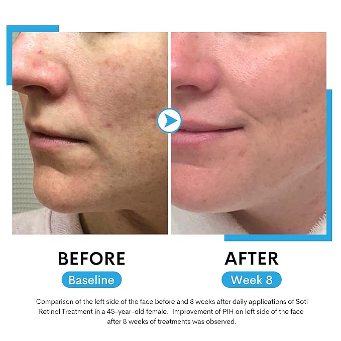 Soti 2.5% Retinol Serum, Reduces Wrinkles, Age Spots, Post-Acne Marks. Stimulates Collagen, Firm Skin, Anti Aging with Hyaluronic Acid, Niacinamide (30ml)