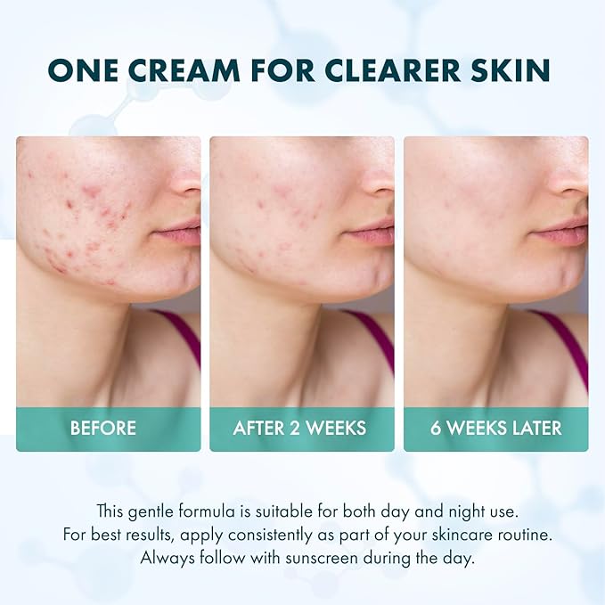 Rossy Azelaic Acid 12% Acne Cream: Advanced Redness Facial Cream - Prevents Acne Breakouts and Clears Pores for Daily Skincare - Anti-Blemish for Men and Women 50 ML