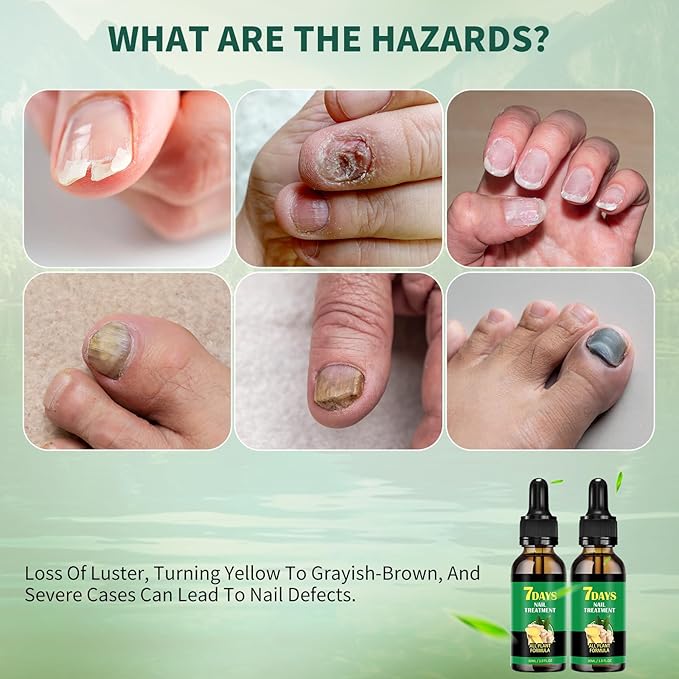 7days Ginger Nail Treatment 2Pcs Nail Support Nail Care, Nail Treatment, Ginger Nail Growth Serum, Ginger Cuticle Care Oil for Nails,Cuticle Serum for Nails