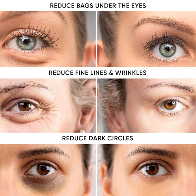 Instant Puffy Eye & Lift Treatment – Removes Under Eye Bags & Puffiness. Eliminate Dark Circles & Wrinkles. Naturally Ageless Hydrating Cream. Disappears Before Your Eyes Within Minutes.