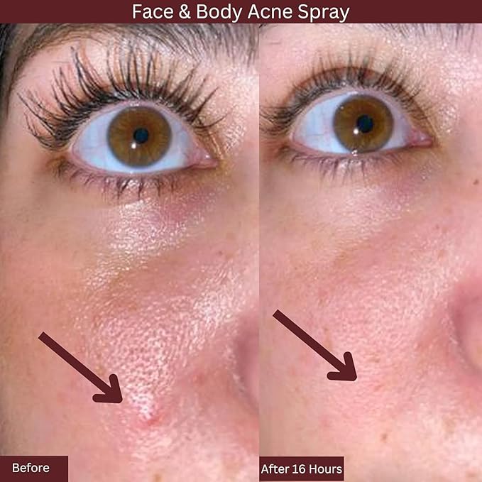 ITK Skincare 2% Salicylic Acid Spray for Face & Body Acne - Blemish-Fighting Treatment for Body Acne, Bacne, Blackheads, Pimples & Blemishes - BHA Blemish Facial Mist Post Workout - 3.3oz Spray Bottle