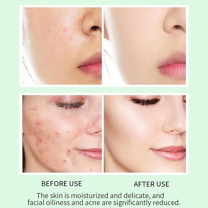 Acne Treatment Serum with 2% Salicylic Acid & Niacinamide-Centella Asiatica Facial Repair Oils for Sensitive & Acne-Prone Skin Acne Spot Treatment Gentle Spot Care Oil Control, 1 Fl Oz