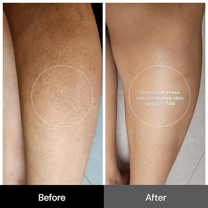 Unscented Lactic Body Lotion With 5% Lactic Acid,Improves Skin Texture & Reduce Strawberry Legs 6.76 Fl Oz