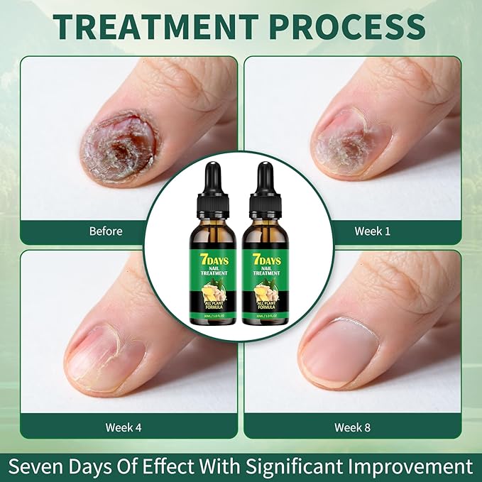 7days Ginger Nail Treatment 2Pcs Nail Support Nail Care, Nail Treatment, Ginger Nail Growth Serum, Ginger Cuticle Care Oil for Nails,Cuticle Serum for Nails