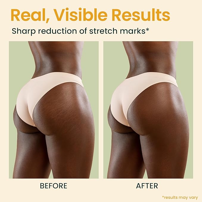 Bio Pure Skincare Oil - Moisturizer for Dry Skin - Pregnancy Stretch Mark Prevention - Oil for Scars - Stretch Mark Treatment with Sweet Almond for skin (4oz)