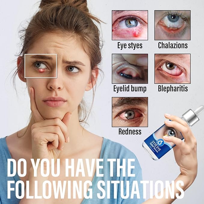 Stye Eye Treatment, Natural Stye Remover, Eye Stye Relief Serum, Premium Formula - Gentle Cleanser for Chalazion & Blepharitis (1 Fl Oz (Pack of 1))