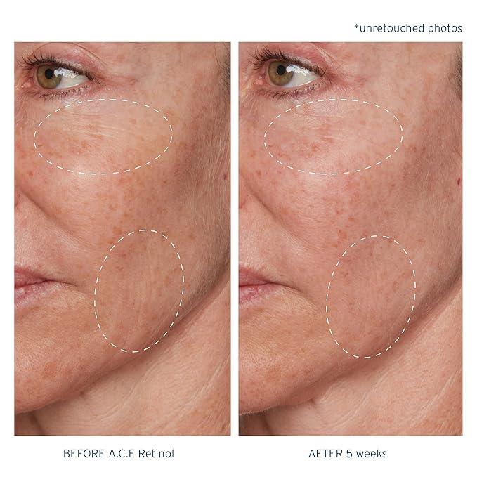 Santo Remedio, Piel Eterna, A.C.E. Retinol Intensive Rejuvenation Oil, Vitamin A, Vitamin C, Vitamin E, Squalane, Salicylic Acid, For Normal, Oily, or Combination Skin, 1 Fl. Oz.