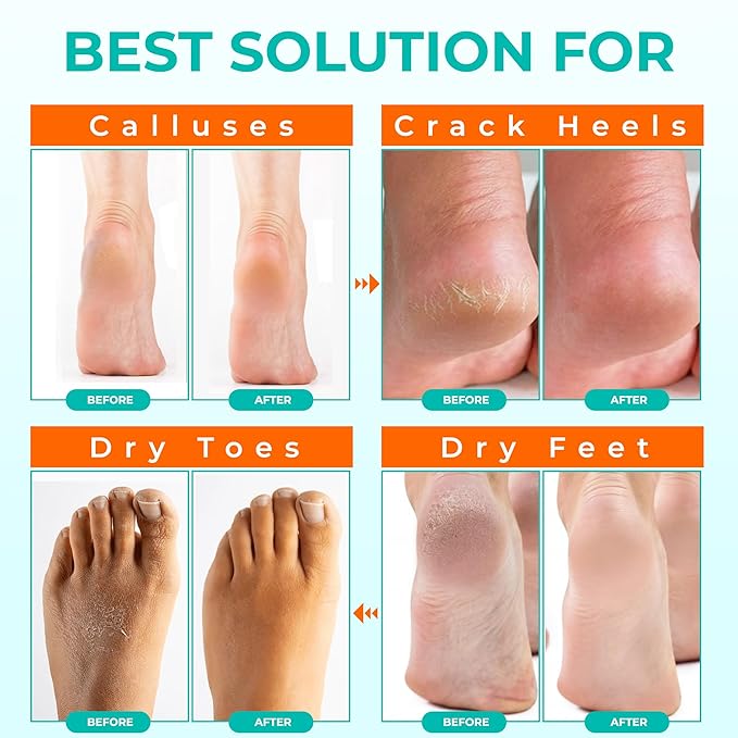 Happy Feet Foot Peel Mask Coconut, 03 Packs Original Exfoliant Foot Peel Mask, Callus Remover for Rough Cracked Dry Feet Dead Skin